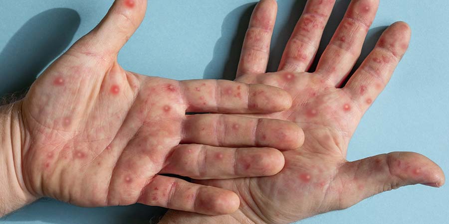 Patient infected with monkeypox virus