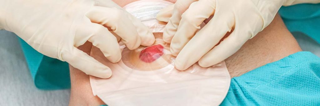 New CE Courses - Ostomy Care now available