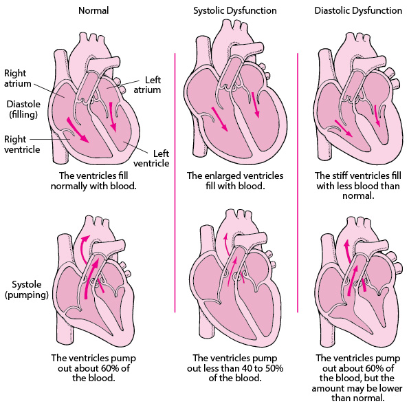 Normal heart function, systolic dysfunction, diastolic dysfunction associated with heart failure.