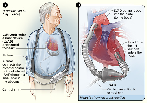 Left ventricular assist device, used to support heart function in patients with heart failure.
