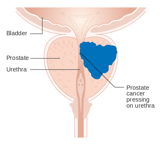Prostate cancer pressing on the urethra