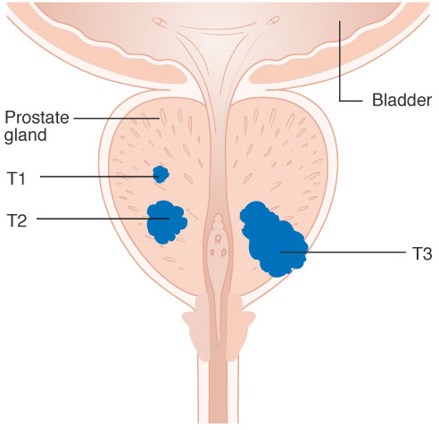 T1, T2, T3 stage, prostate cancer