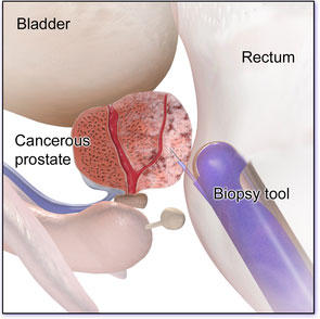 Fine needle biopsy method for prostate cancer diagnosis
