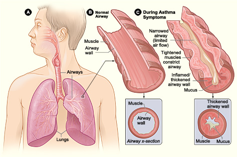 Pathophysiology of an asthma attack