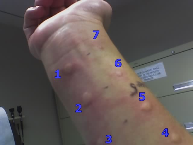 Testing for allergic reactions using intradermal injection
