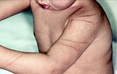 Evidence of arm injuries indicating child abuse