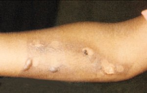 Evidence of arm burn injury, indicating child abuse