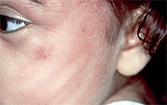 Evidence of bruising on face indicating possible child abuse