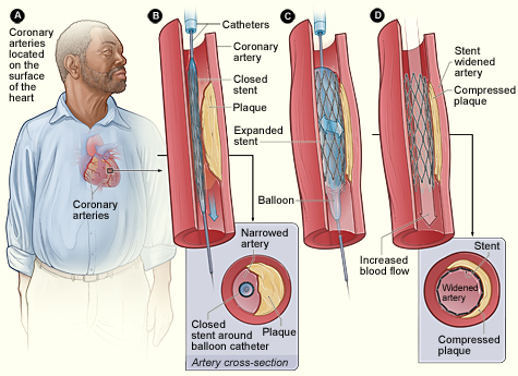 Illustration of coronary angioplasty (PCI) to widen a coronary artery