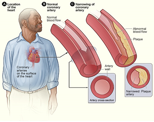 Diagram of atherosclerosis showing narrowing of an artery due to plaques, resulting in abnormal blood flow