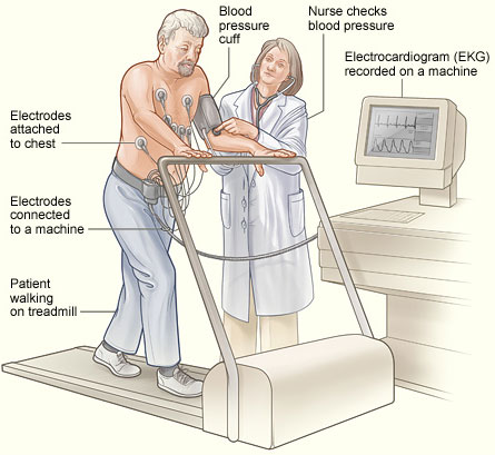 Illustration of stress testing to assess for coronary artery disease