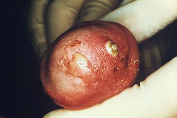View of penis showing symptoms of gonorrhea infection