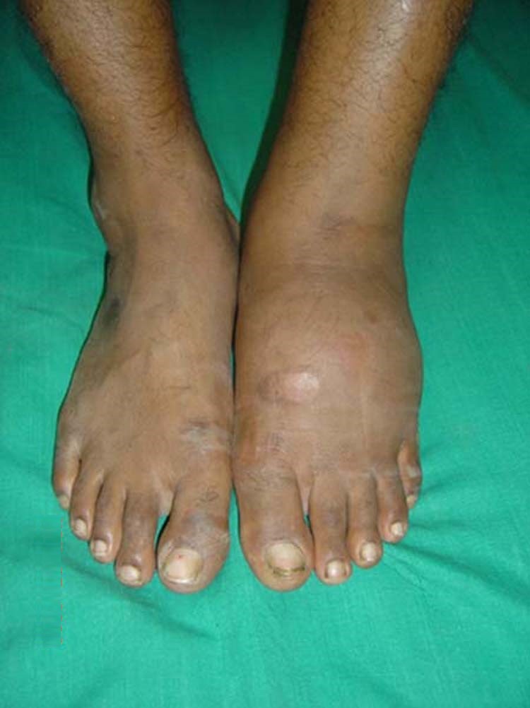 Photo showing Charcot foot