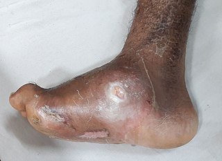 Photo of Charcot foot deformity with an ulcerated abscess