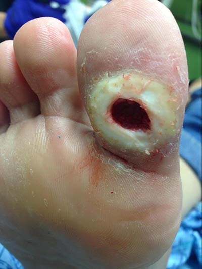 Photo of a diabetic foot ulcer