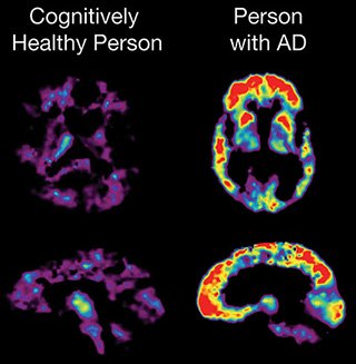 PET scans showing comparison of cognitively healthy person and person with Alzheimer’s disease