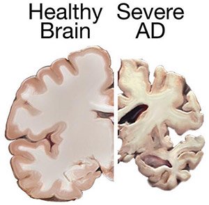 Size of a healthy brain compared to a brain with severe AD.