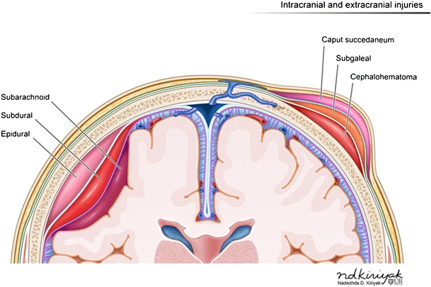 Illustration showing hemorrhages by location within the layers of the meninges
