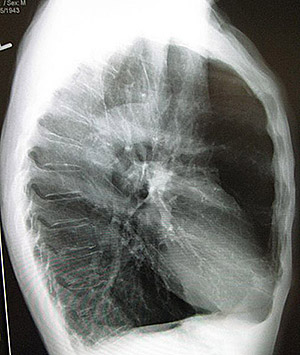 Image of a chest x-ray of an individual with a barrel chest