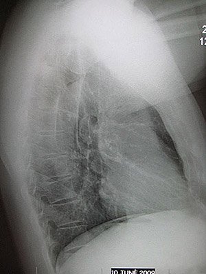 Image of a normal chest x-ray