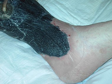 Photograph showing a negative-pressure dressing for wound therapy and healing