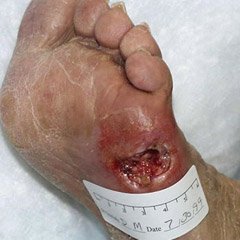 Photograph of a nonhealing diabetic foot ulcer