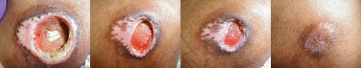 Photographs of a pressure injury healing by secondary wound closure