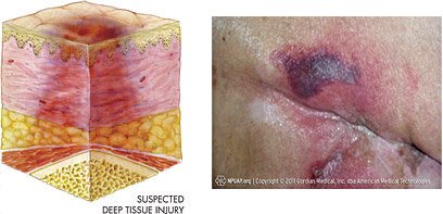Illustration and photo of deep tissue pressure injury