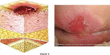 Illustration and photo of stage 2 pressure injury