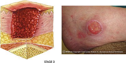 Illustration and photo of stage 3 pressure injury
