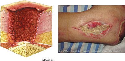 Illustration and photo of stage 4 pressure injury