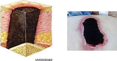 Illustration and photo of unstageable pressure injury