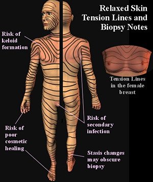 Illustration of skin tension lines and areas of highest risk for infection