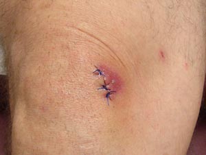 Photo of a sutured laceration showing healing wound either in inflammatory phase or with infection