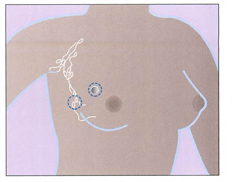 Lumpectomy sites for breast cancer treatment