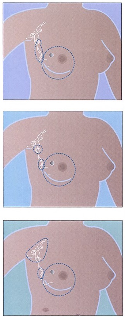 Simple, modified radical, and radical mastectomy sites