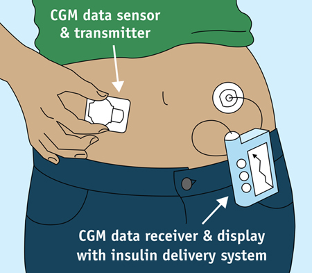 Illustration of a continuous glucose monitor.