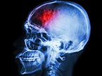X-ray image of skull from the side in blue with red blod clot area for stroke