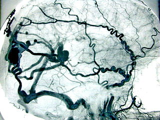 Brain AVMs: dilated tangled blood vessels in the brain