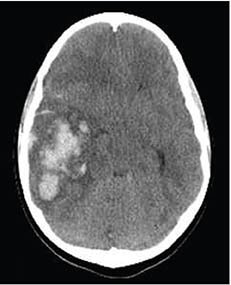 image of CT scan showing a hemorrhagic stroke