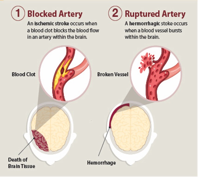 Illustration showing the two types of stroke.
