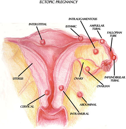 Illustration showing ectopic pregnancy implantation sites