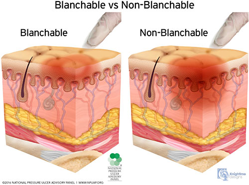 Blanchable vs. nonblanchable erythema