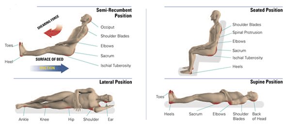 High-risk areas for pressure injuries according to body position