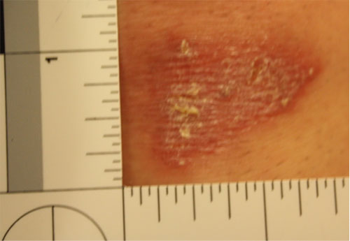 Forensic examination close-up photo with a scale of a patient injury.