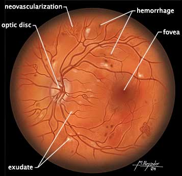 Microscopic view of retinal damage due to diabetes