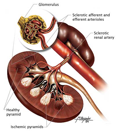 Diabetic nephropathy impacts the kidney; kidney structure illustrated