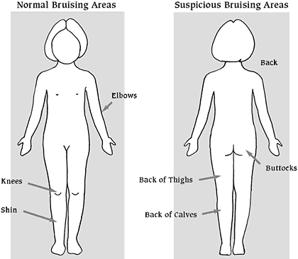 Assessing bruises for possible indications of child abuse