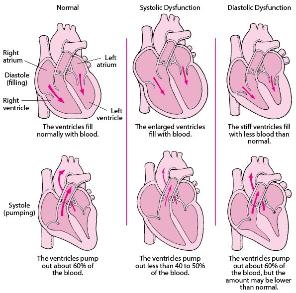 Normal heart function, systolic dysfunction, and diastolic dysfunction associated with heart failure.