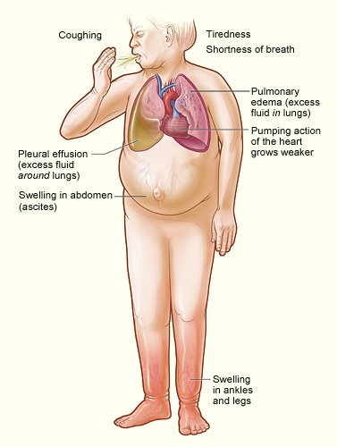 Heart failure indicators.